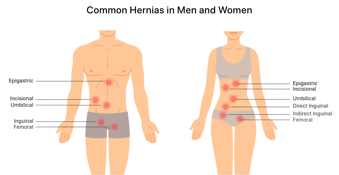 Clinical Notes Regarding Hernias