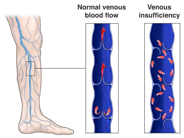 Chronic Venous Disease Ultrasound