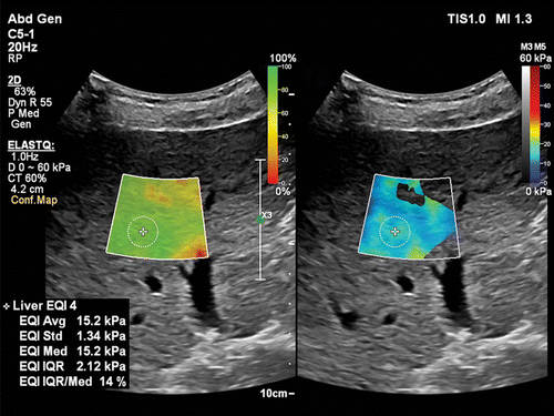Liver Elastography Ultrasound