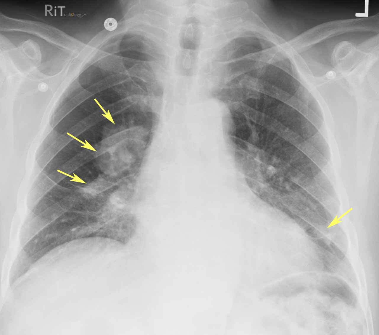 ILO Chest X-rays