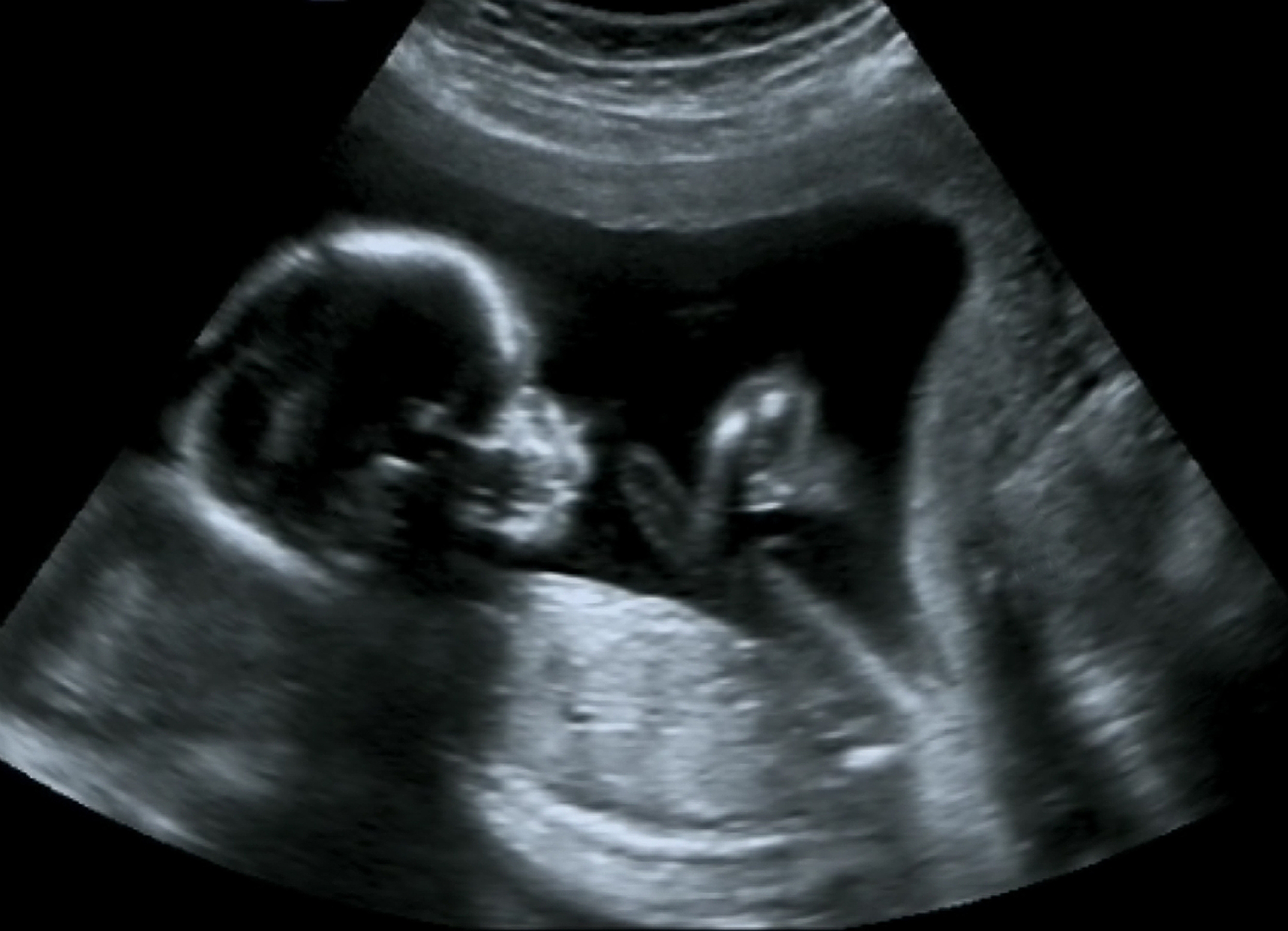Nuchal Translucency - For all sonographers to read!